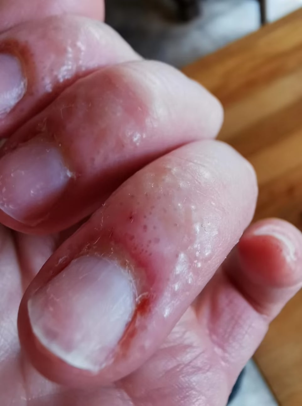 Understanding Nail Allergies: What Every Nail Tech Needs to Know